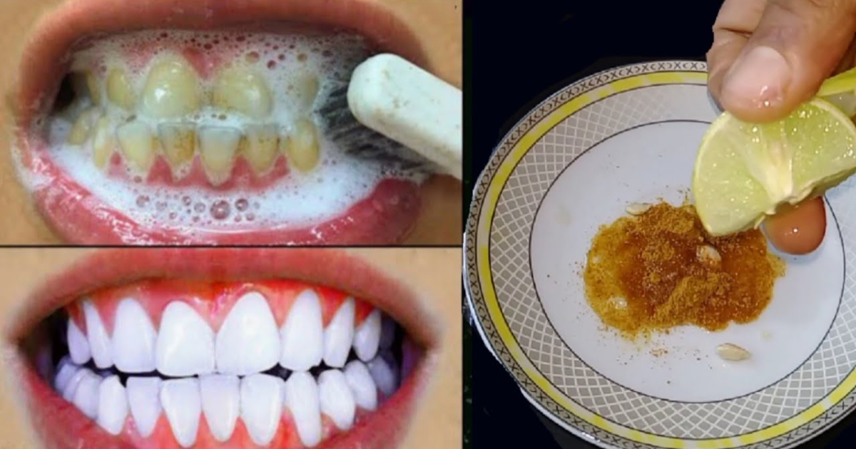 teeth whittening tips