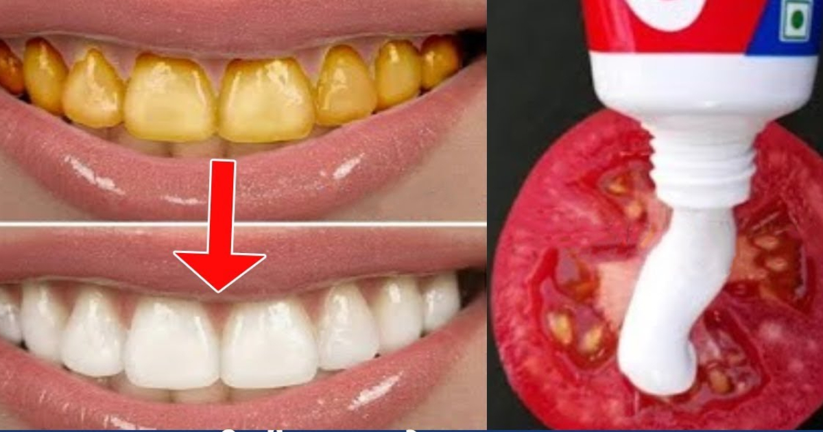 Teeth Whitening Home Remedy